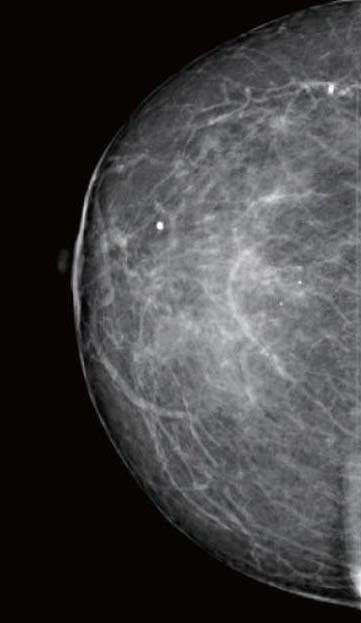 乳腺正常放射学表现